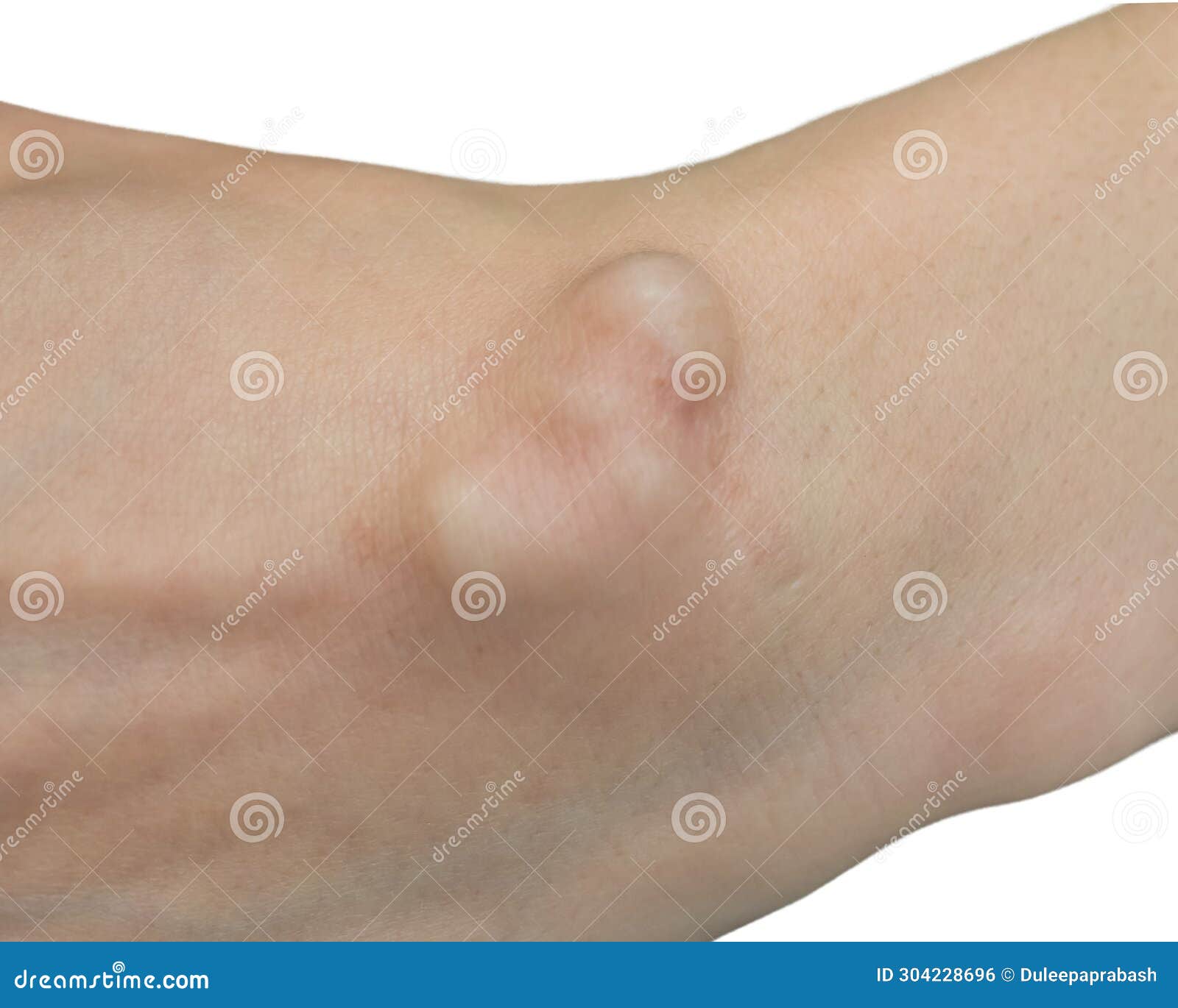 Lump Near Anus Female Painful