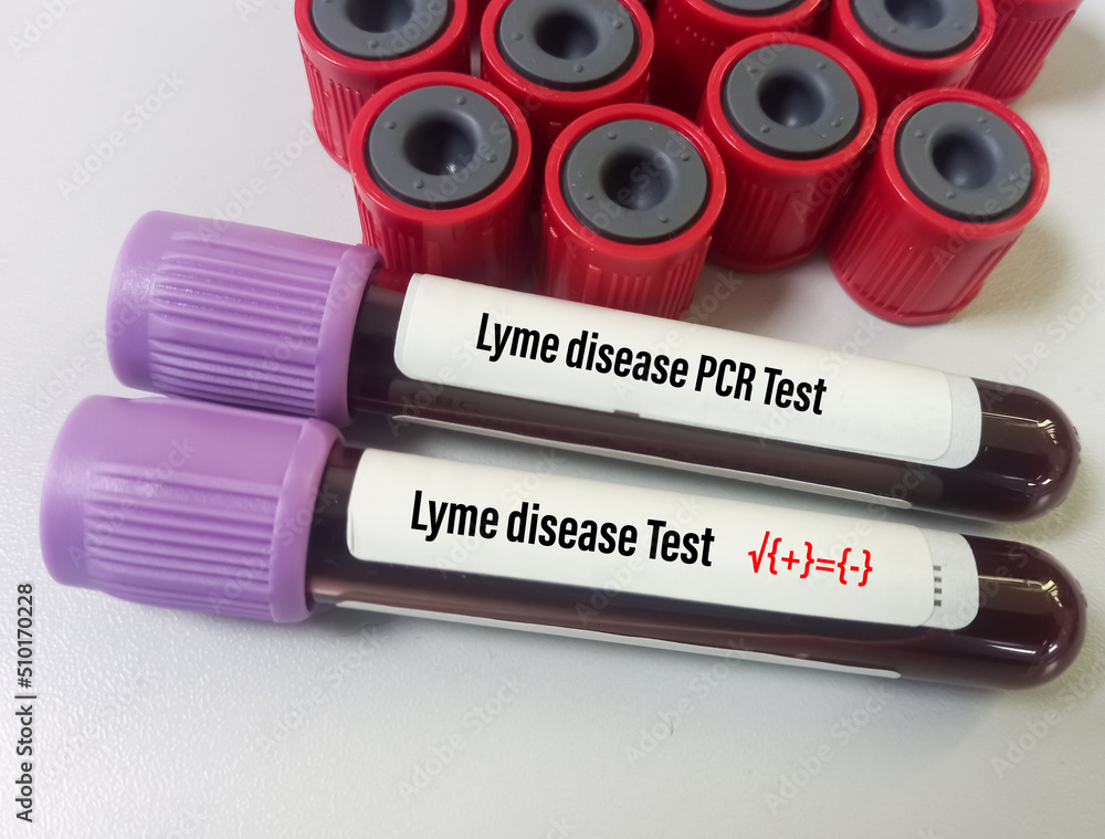 Lyme Disease Blood Test
