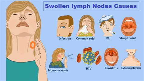 Lymph Glands Swollen