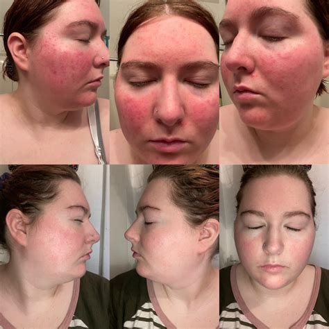 Metrogel For Rosacea