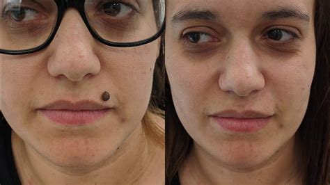 Mole On Face Removed