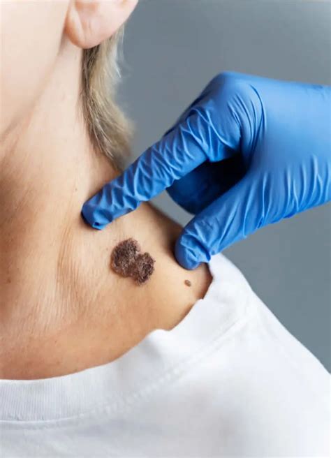Mole Removal In Jersey City Dermatologist Mole Removal Mole Removal In Jersey City Dermatologist Mole Removal