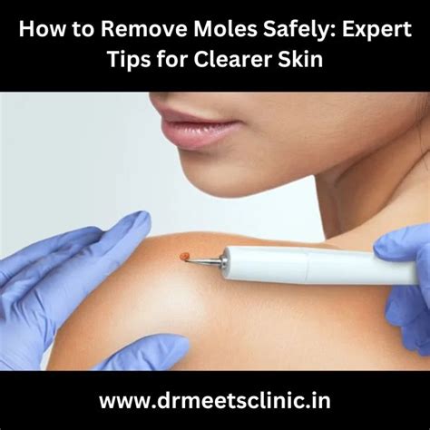 Moles Remove Safely