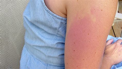 Most Vaccines Can Be Given Safely Even After Reactions Most Vaccines Can Be Given Safely Even After Reactions