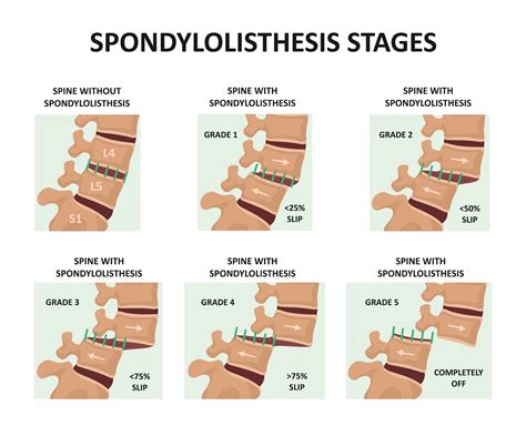 Multilevel Lumbar Spondylosis: Comprehensive Treatment