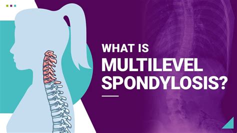 Multilevel Lumbar Spondylosis