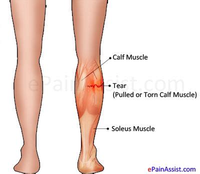 Muscle Pull In Calf