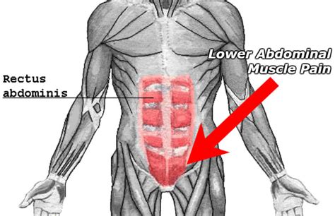 Muscle Strain Abdominal