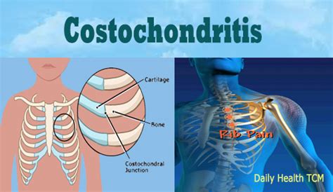 Musculoskeletal Chest Pain