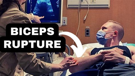 My Distal Bicep Tear Recovery After Tendon Repair Surgery Youtube