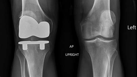 My New Knee Running Again After A Total Knee Replacement Uphill Athlete