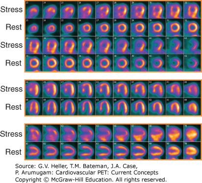 Myocardial Perfusion Scan
