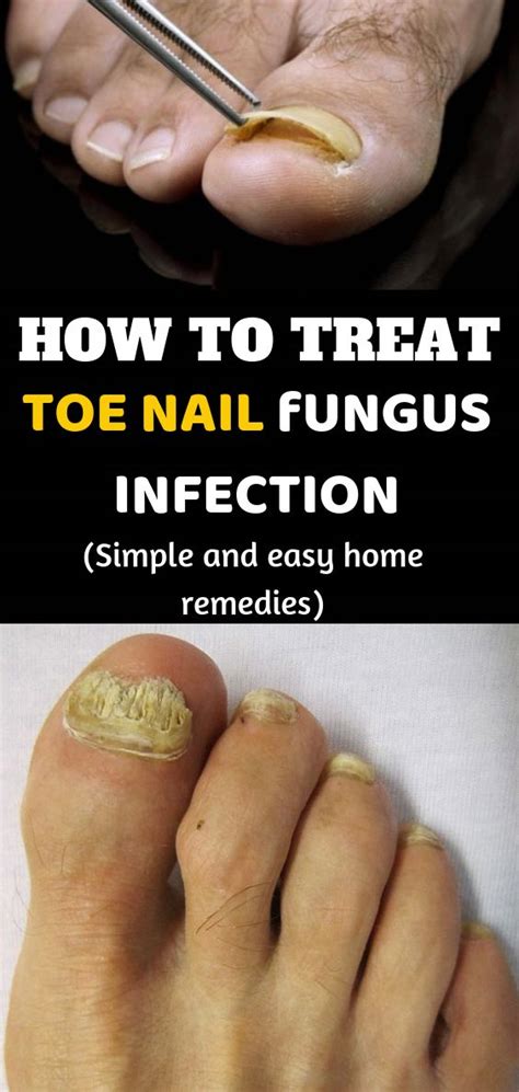 Nail Detached: Fix With Simple Home Treatments