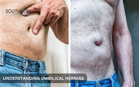 Navel Hernia Surgery