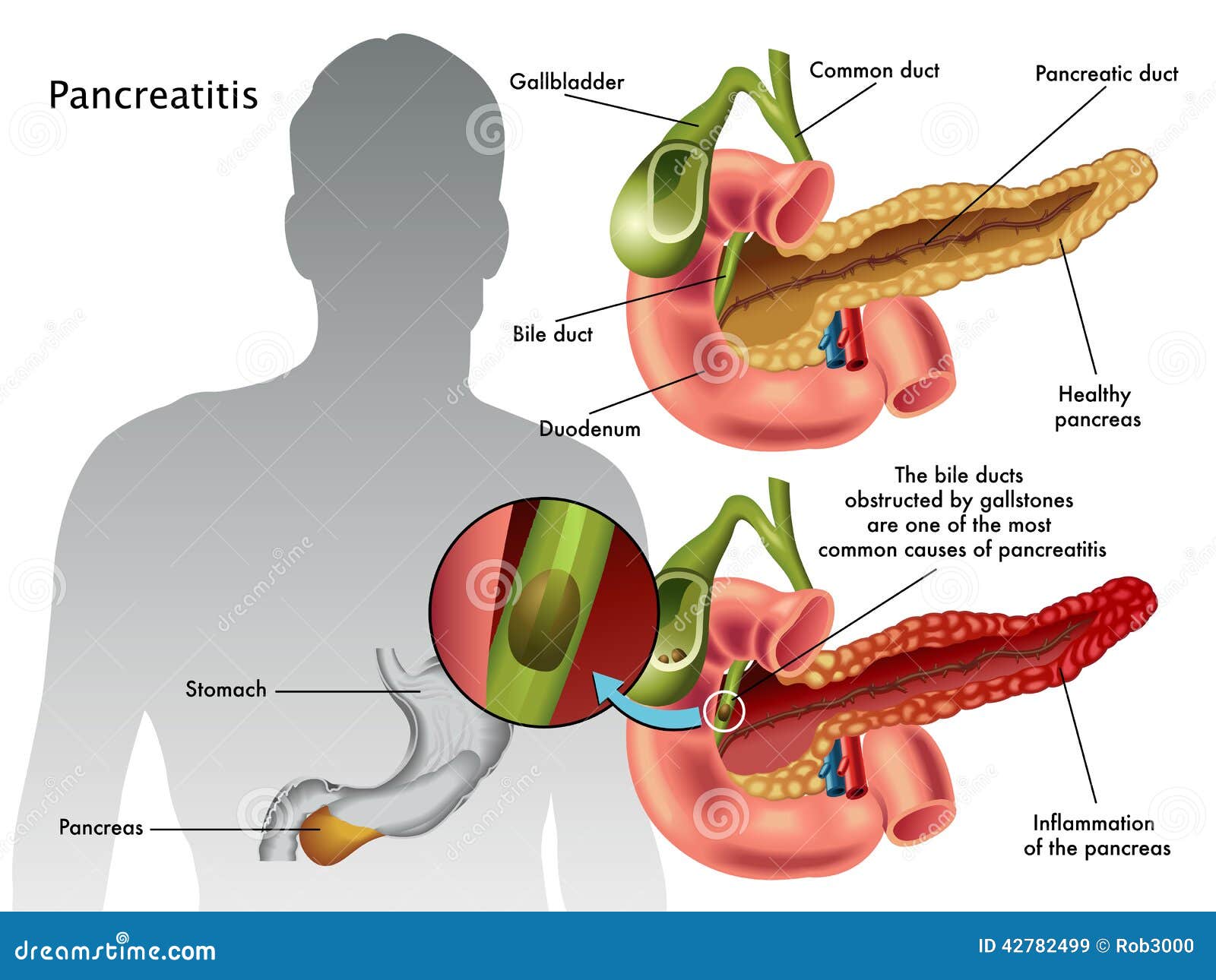Pancreatitis Explained: Comprehensive Guide Inside