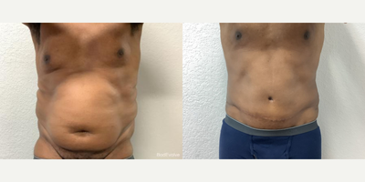 Panniculectomy: Relieves Excess Skin