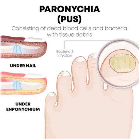 Paronychia Healing Stages