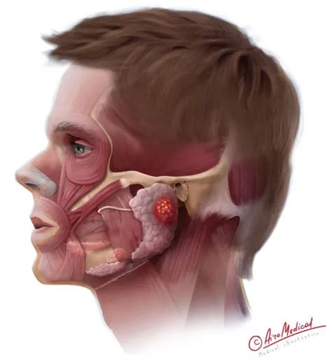Parotid Infection Guide: Symptoms & Treatment