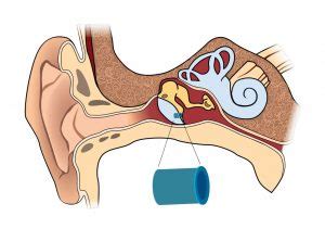 Pe Tube Ear Solutions: Relief Explained