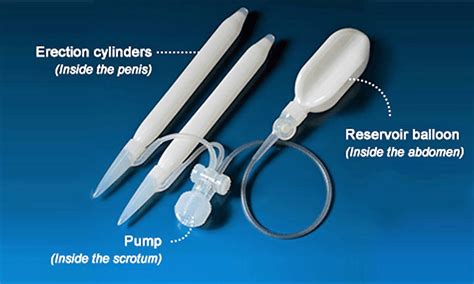 Penile Implant Surgery