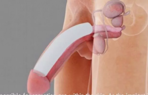 Penis Implant Surgery