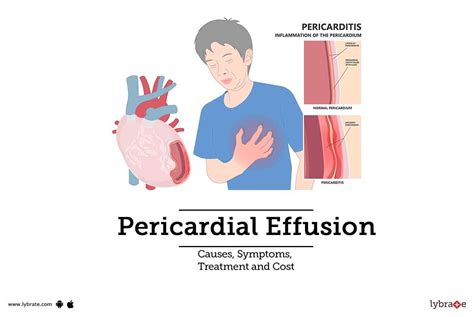 Pericardial Effusion Symptoms