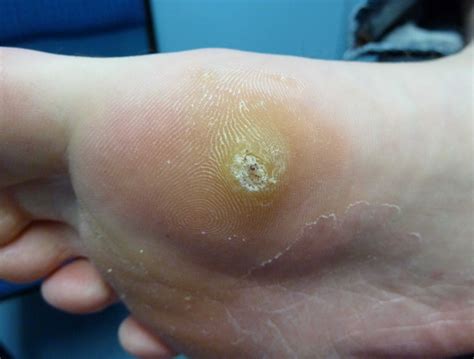 Plantar Wart Removal Chicago At David Barden Blog Plantar Wart Removal Chicago At David Barden Blog