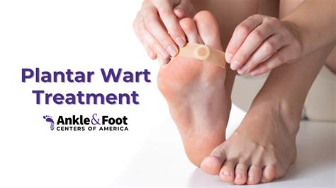 Plantar Wart Treatments