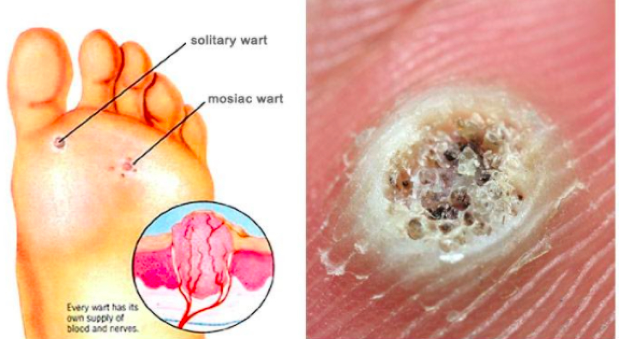 Plantar Wart Wart