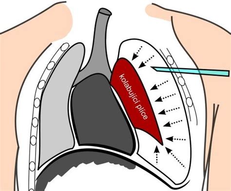 Pneumothorax Chest Tube Management
