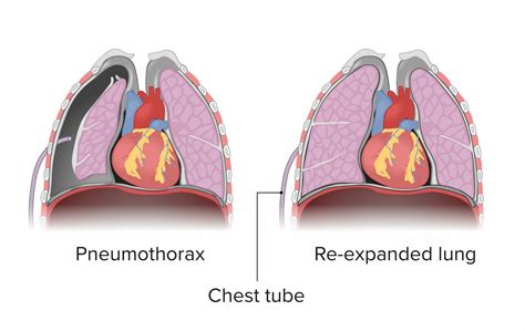 Pneumothorax Chest Tube