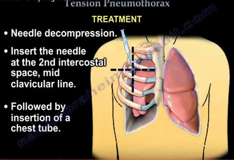 Pneumothorax Treatment: Insertion Guide