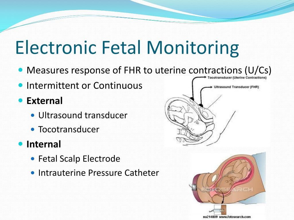 Ppt Electronic Fetal Monitoring Powerpoint Presentation Free Ppt Electronic Fetal Monitoring Powerpoint Presentation Free
