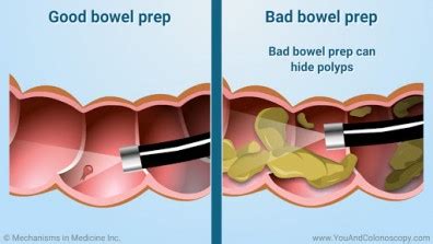 Preparation For Colonoscopy