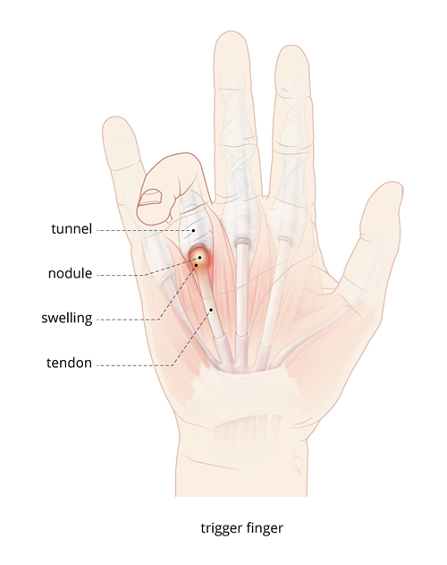 Problems After Trigger Finger Surgery