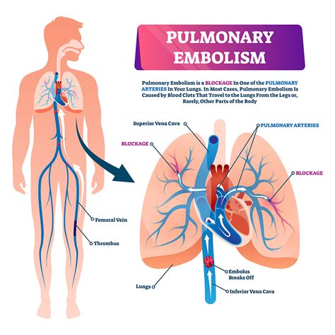 Pulmonary Embolism Embolism
