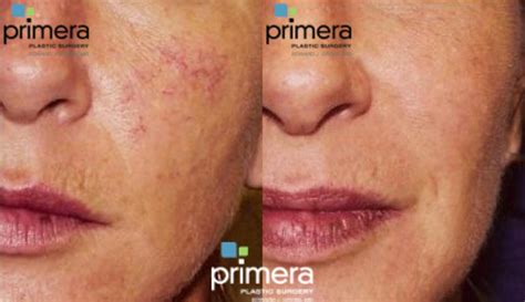 Pulsed Dye Laser: Treats Skin Imperfections