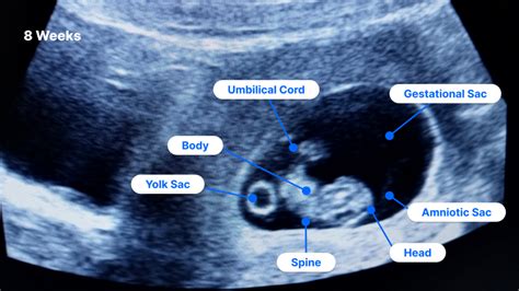 Real 8 Week Fetus