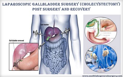 Recovery Time For Gallbladder Surgery