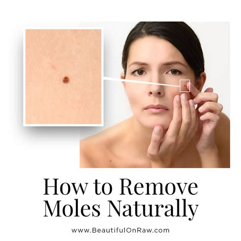 Remove Moles On Skin