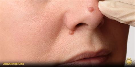Remove Moles: Safe Athome Solutions
