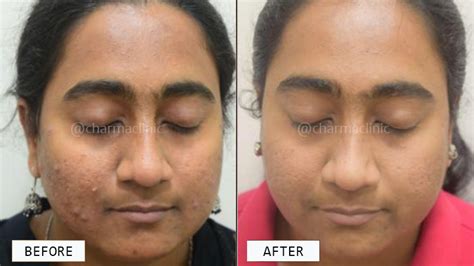 Results Before And After Charma Clinic Results Before And After Charma Clinic