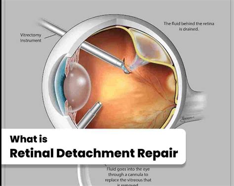 Retinal Detachment Surgery: Repair Guide