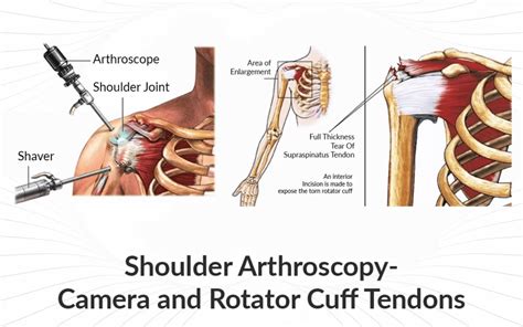 Rotator Cuff Surgery: Fast Recovery Tips