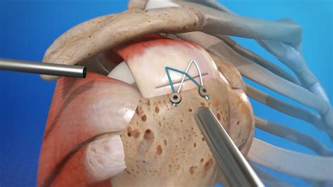 Rotator Cuff Surgery