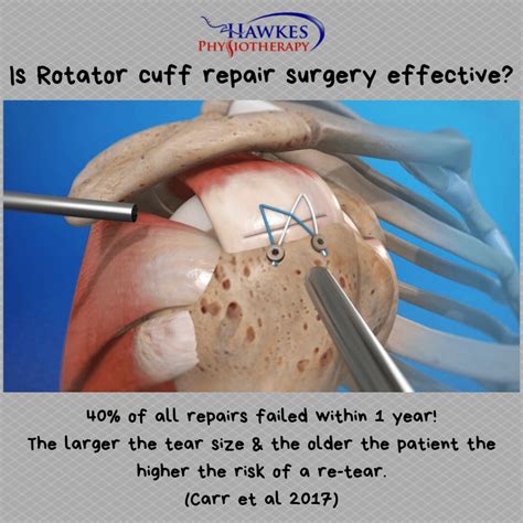 Rotator Cuff Tear Surgery