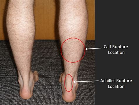 Ruptured Calf Muscle
