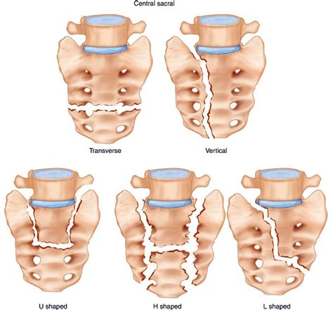 Sacral Bone Fracture