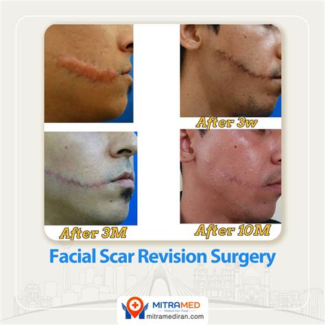 Scar Revision Surgery Cost