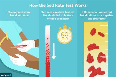 Sed Rate Blood Test High
